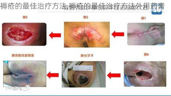 褥疮的最佳治疗方法,褥疮的最佳治疗方法外用药膏